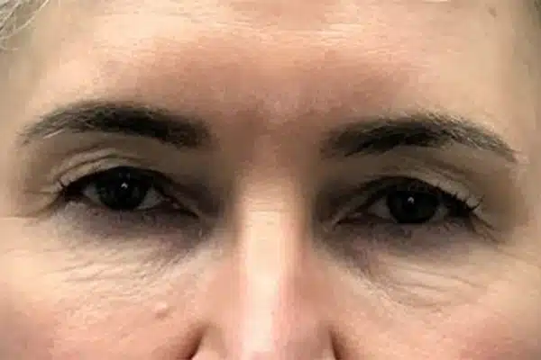 image-undereye-before-3