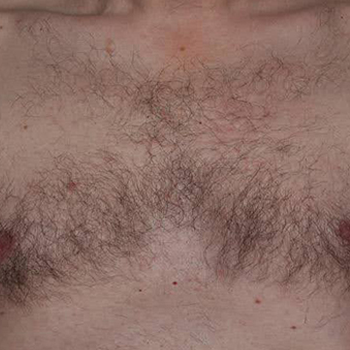 image-unwanted-hair-1_before-1