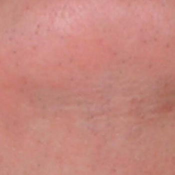 image-unwanted-hair-2_after-1