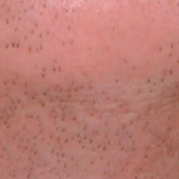 image-unwanted-hair-2_before-1
