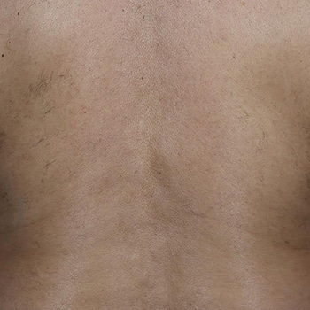 image-unwanted-hair-3_after-1