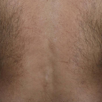 image-unwanted-hair-3_before-1