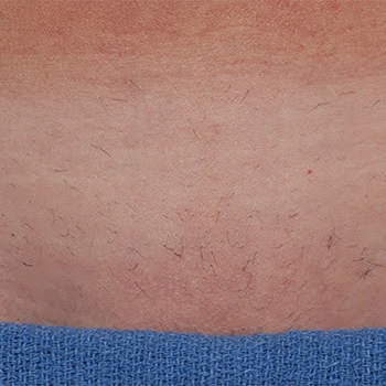 image-unwanted-hair-4_after-1