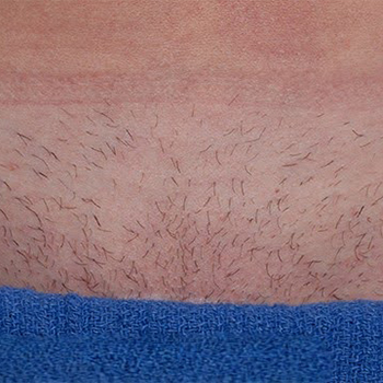 image-unwanted-hair-4_before-1