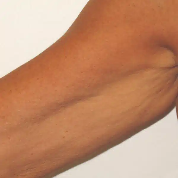 image-venus-legacy-before-after-3_after