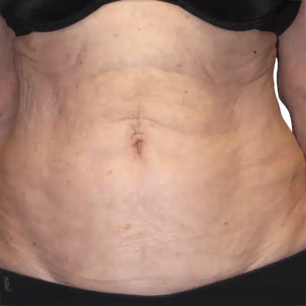 image-venus-legacy-before-after-4_after