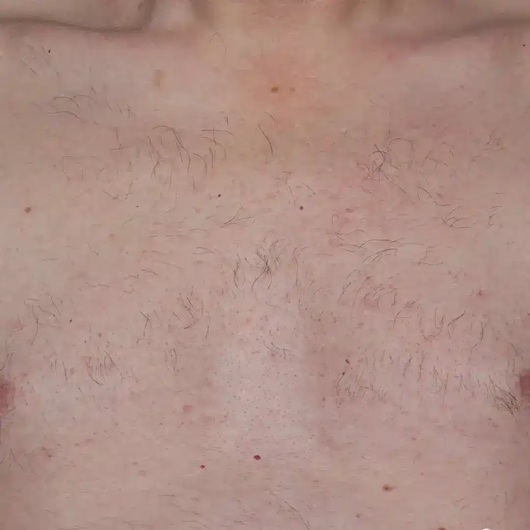 image-hair-removal-after-2_1x-1
