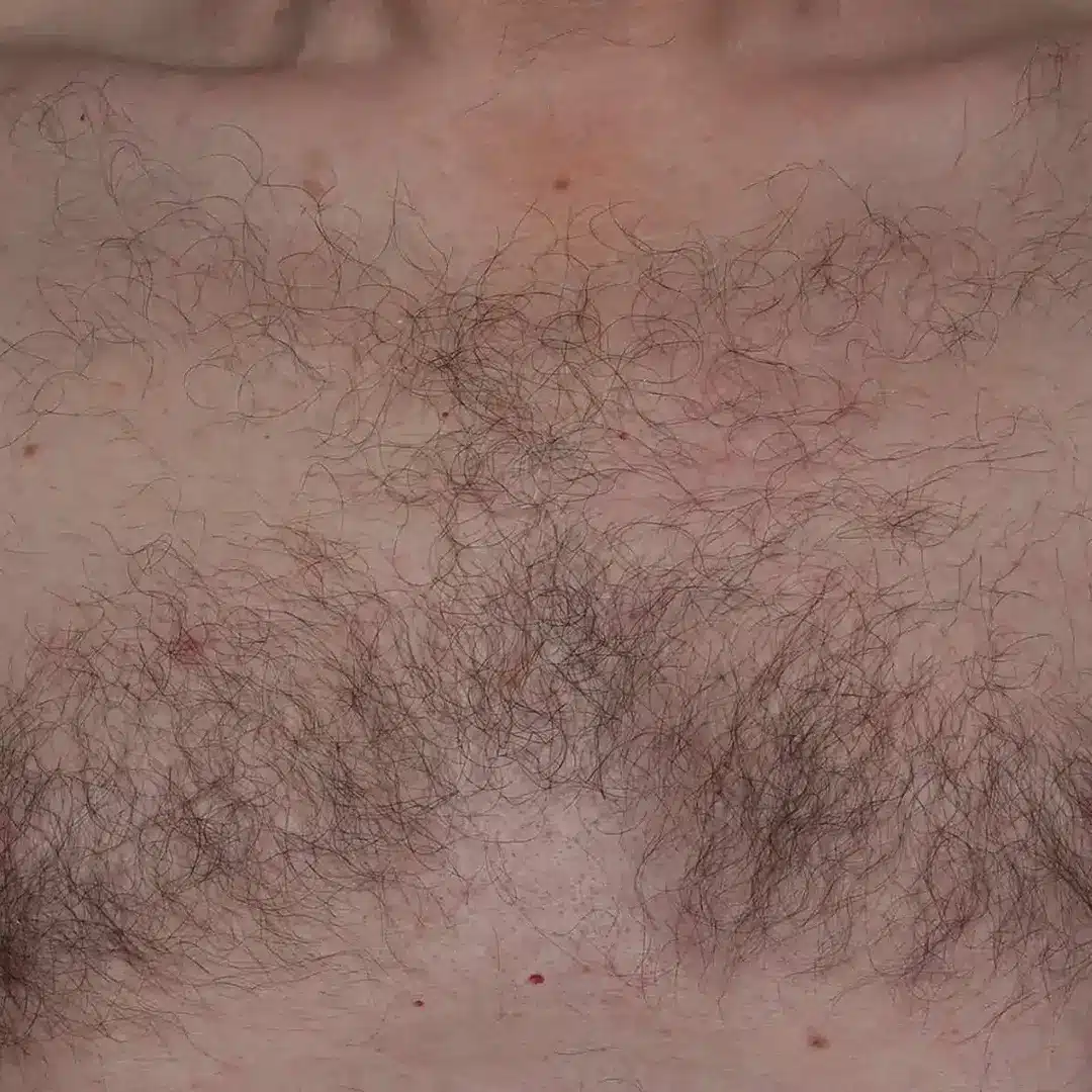 image-hair-removal-before-2_1x1