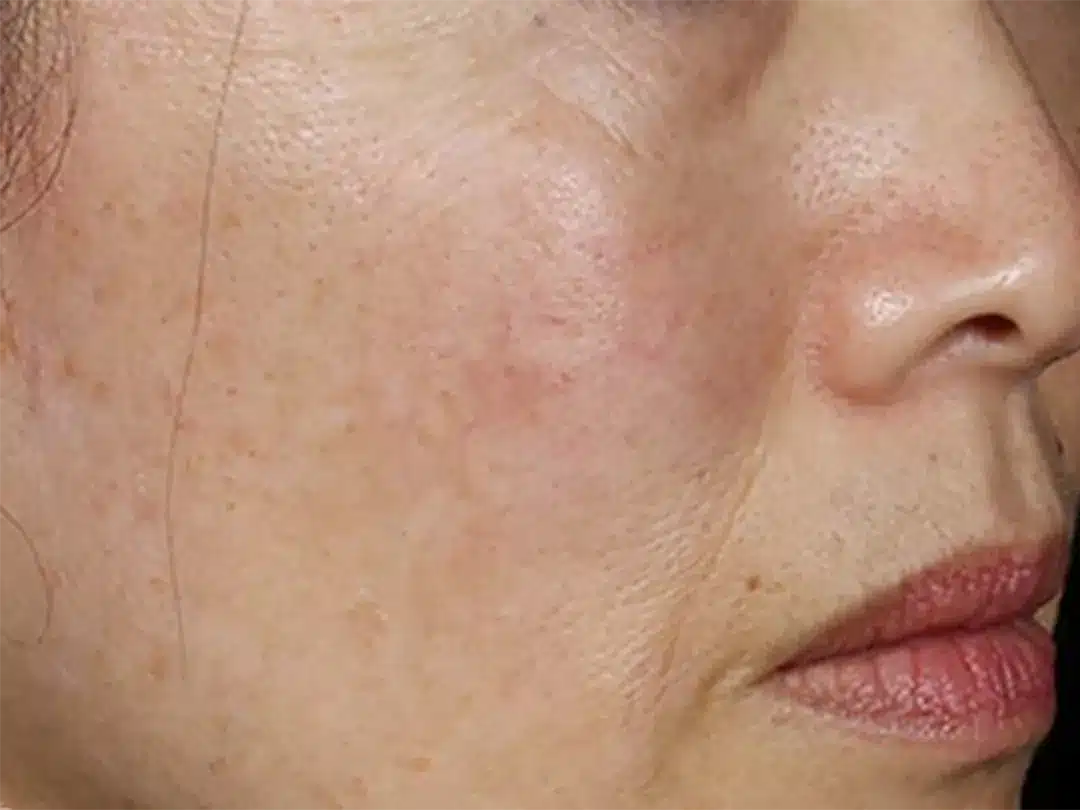 image-laser-genesis-after-4