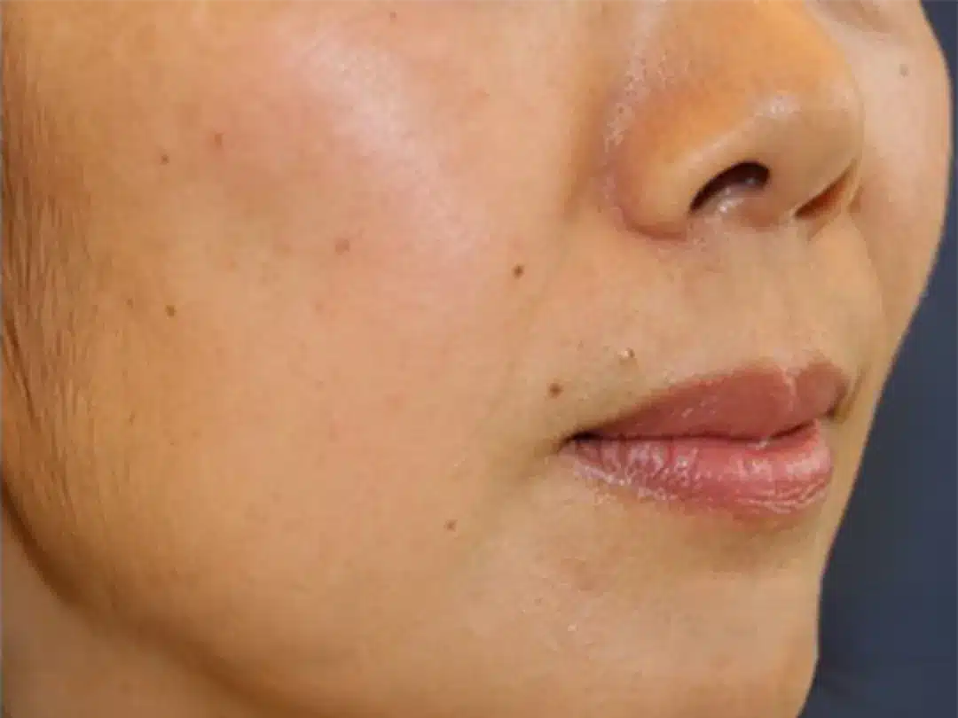 image-laser-genesis-after-5