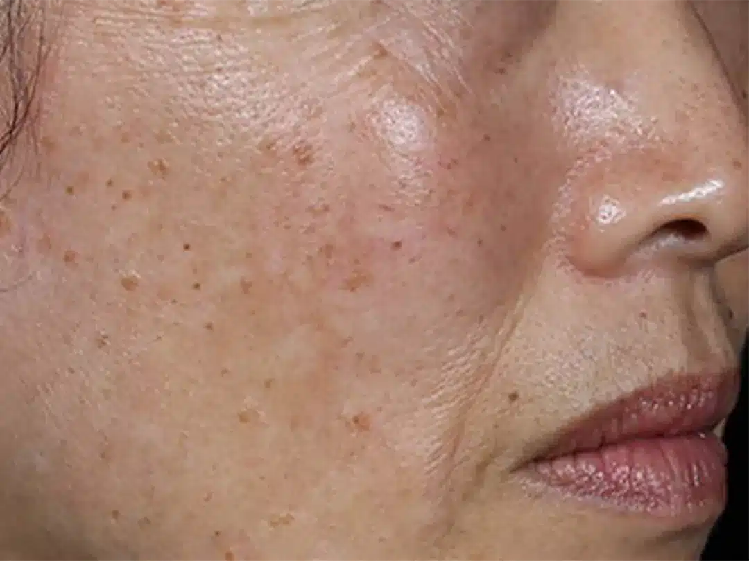 image-laser-genesis-before-4