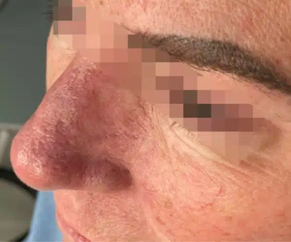 Excel V+ Laser Before and After Broken Capillary Treatment