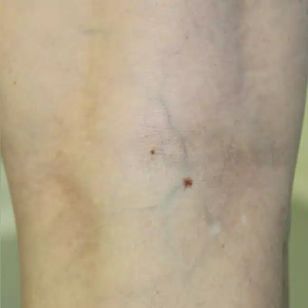 Excel V+ Laser Spider Vein Removal Results