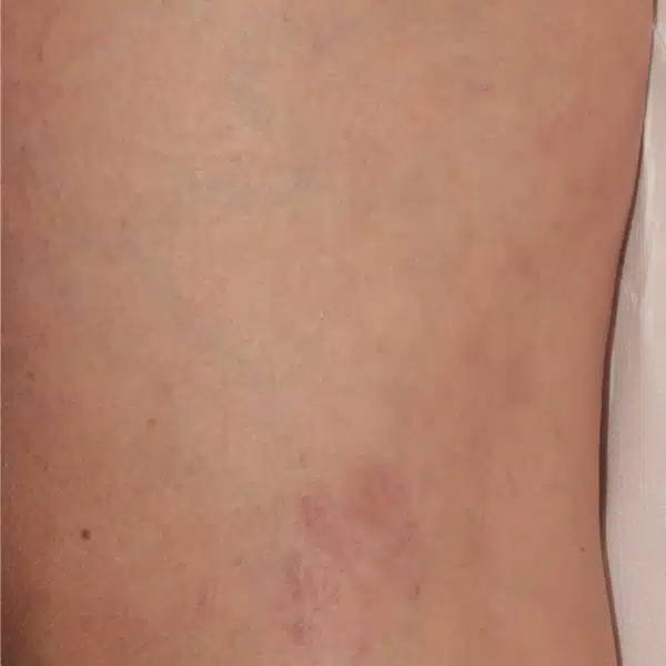 Excel V+ Laser Spider Vein Removal Results