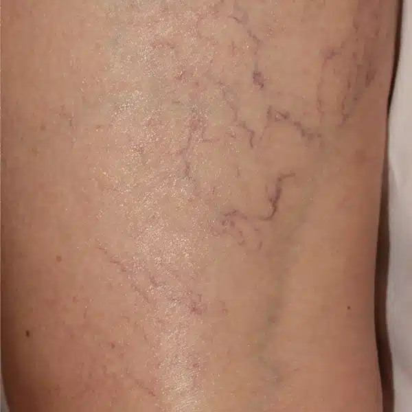 Excel V+ Laser Before and After Leg Vein Treatment