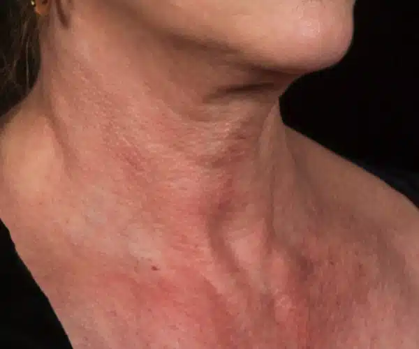 Excel V+ Laser Before and After Neck Redness Treatment