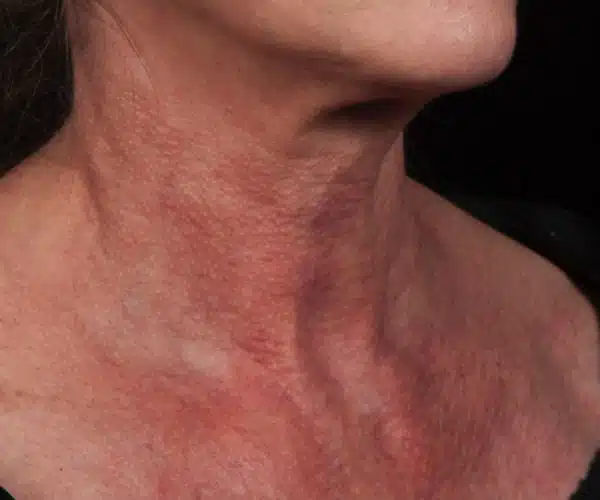Excel V+ Laser Before and After Neck Redness Treatment