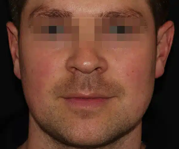 Excel V+ Laser Before and After Rosacea Treatment in Calgary