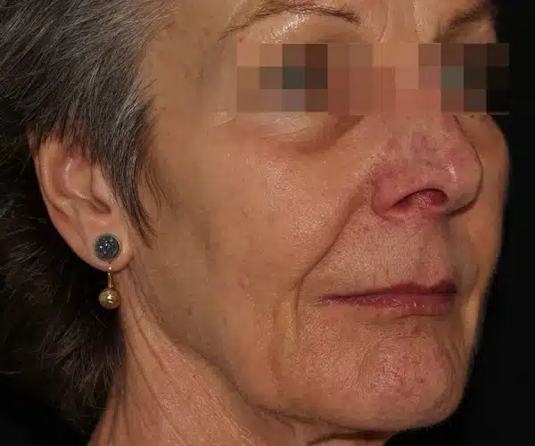 Excel V+ Laser Rosacea & Redness Reduction Results