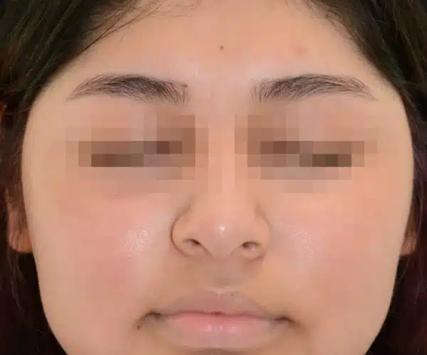 Excel V+ Laser Treatment for Facial Redness