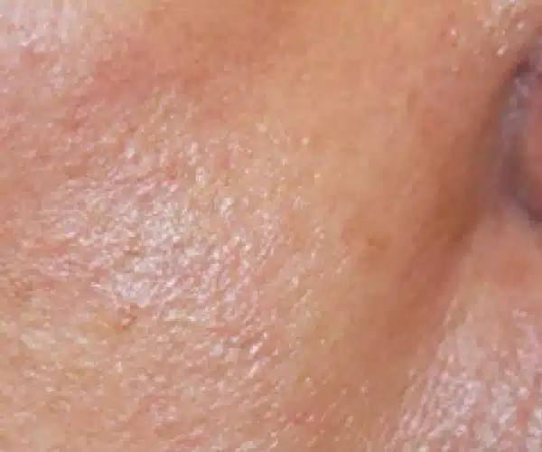Excel V+ Laser Before and After Skin Redness Treatment