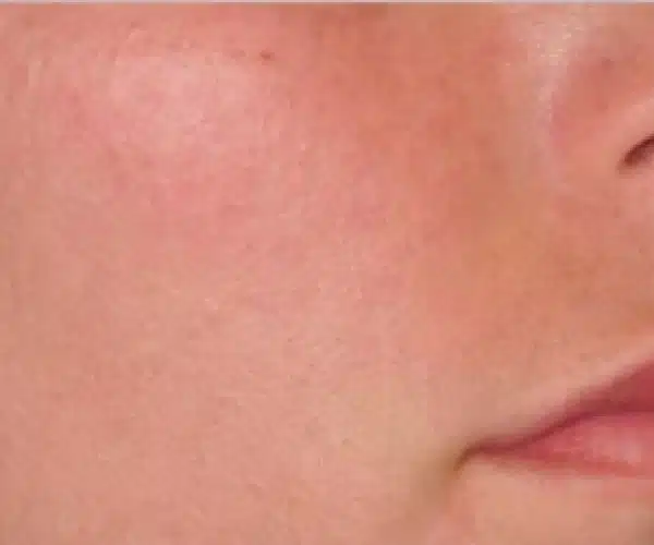 Excel V+ Laser Rosacea Before and After Results