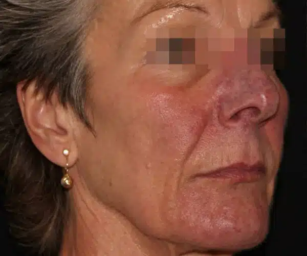 Excel V+ Laser Rosacea & Redness Reduction Results