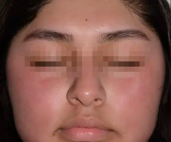 Excel V+ Laser Treatment for Facial Redness