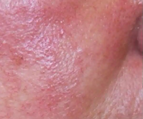 Excel V+ Laser Before and After Skin Redness Treatment