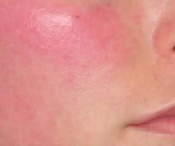 Excel V+ Laser Rosacea Before and After Results