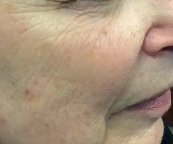 Excel V+ Laser Before and After Skin Texture Treatment