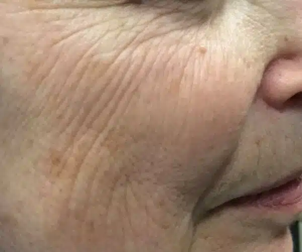 Excel V+ Laser Before and After Skin Texture Treatment