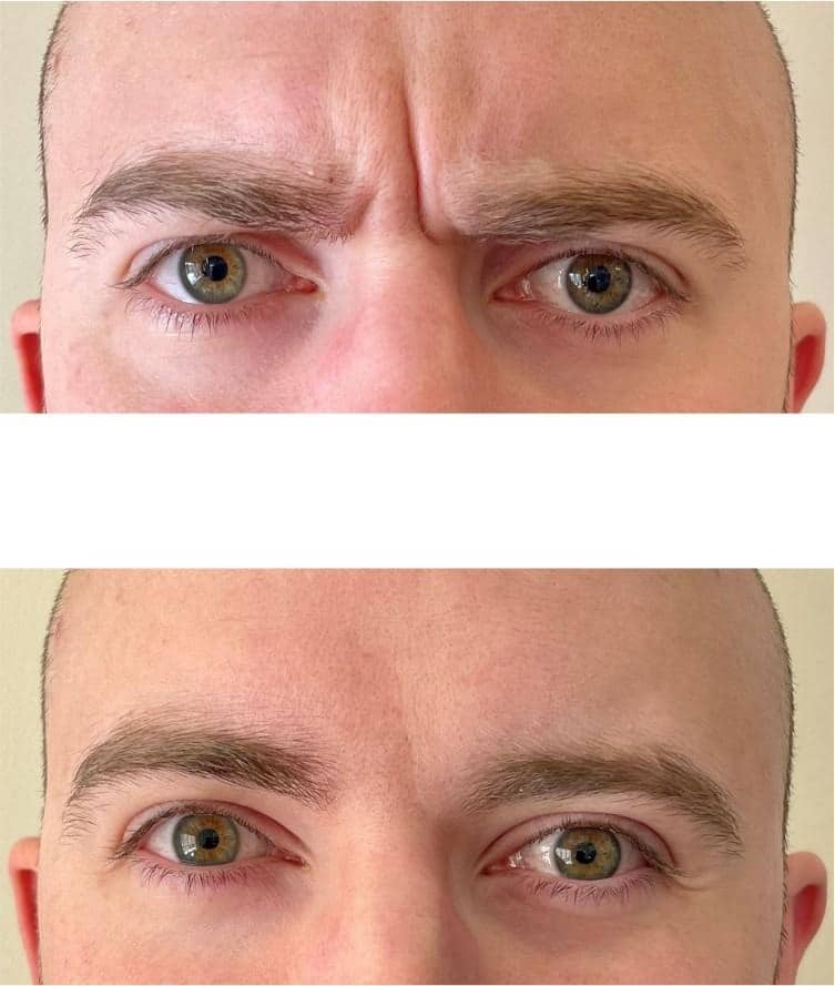 Before and after results of Botox treatment for frown lines