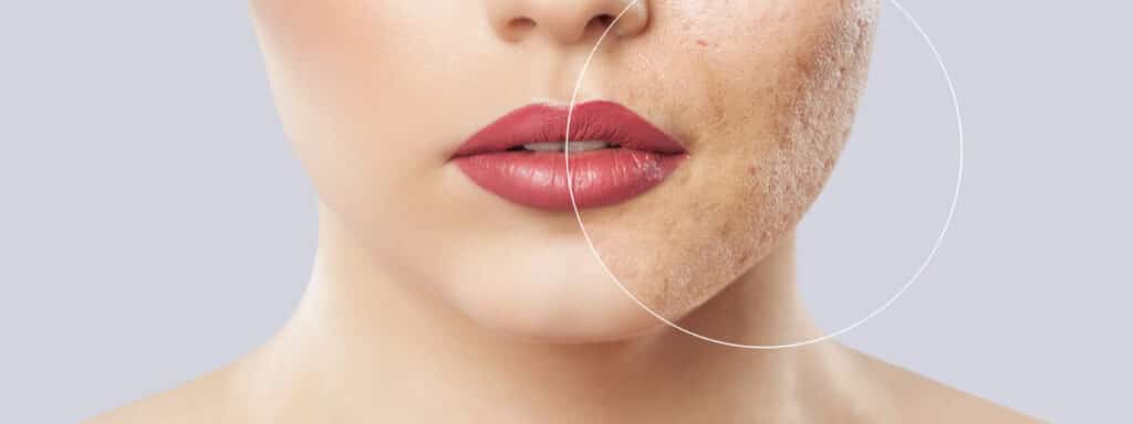 face acne scarring woman