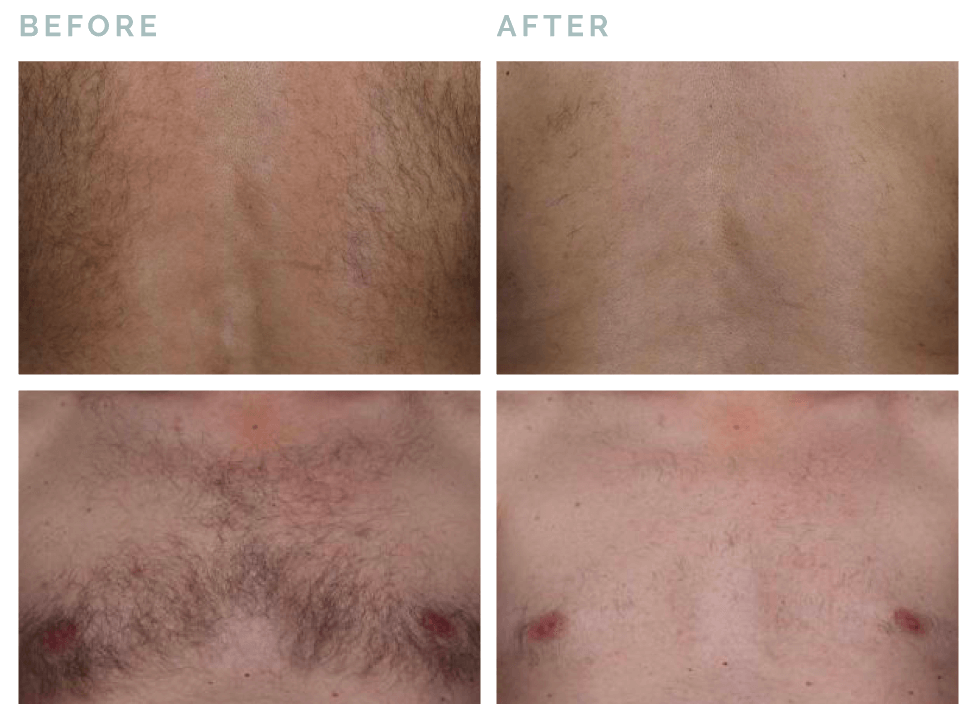Hair Removal Before & After