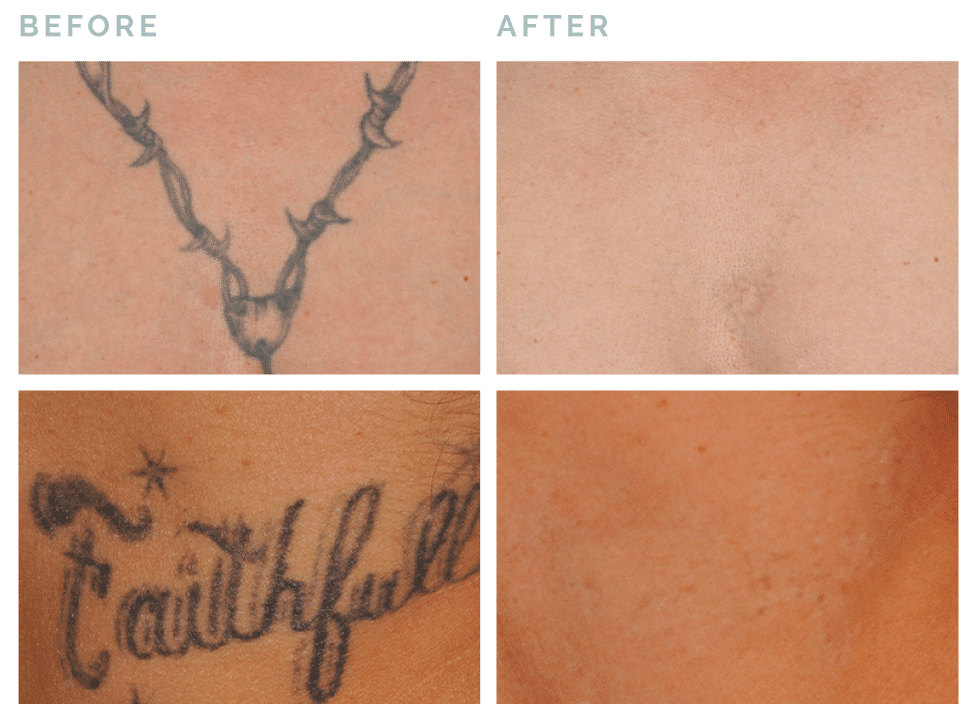 Vive® Rejuvenation tattoo removal