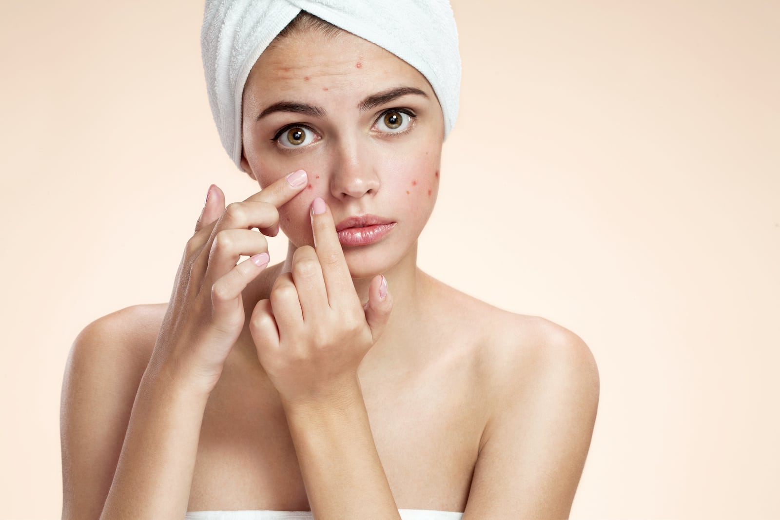 Woman with acne spot pimple